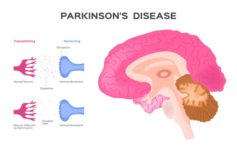 AI for Parkinson’s Patients